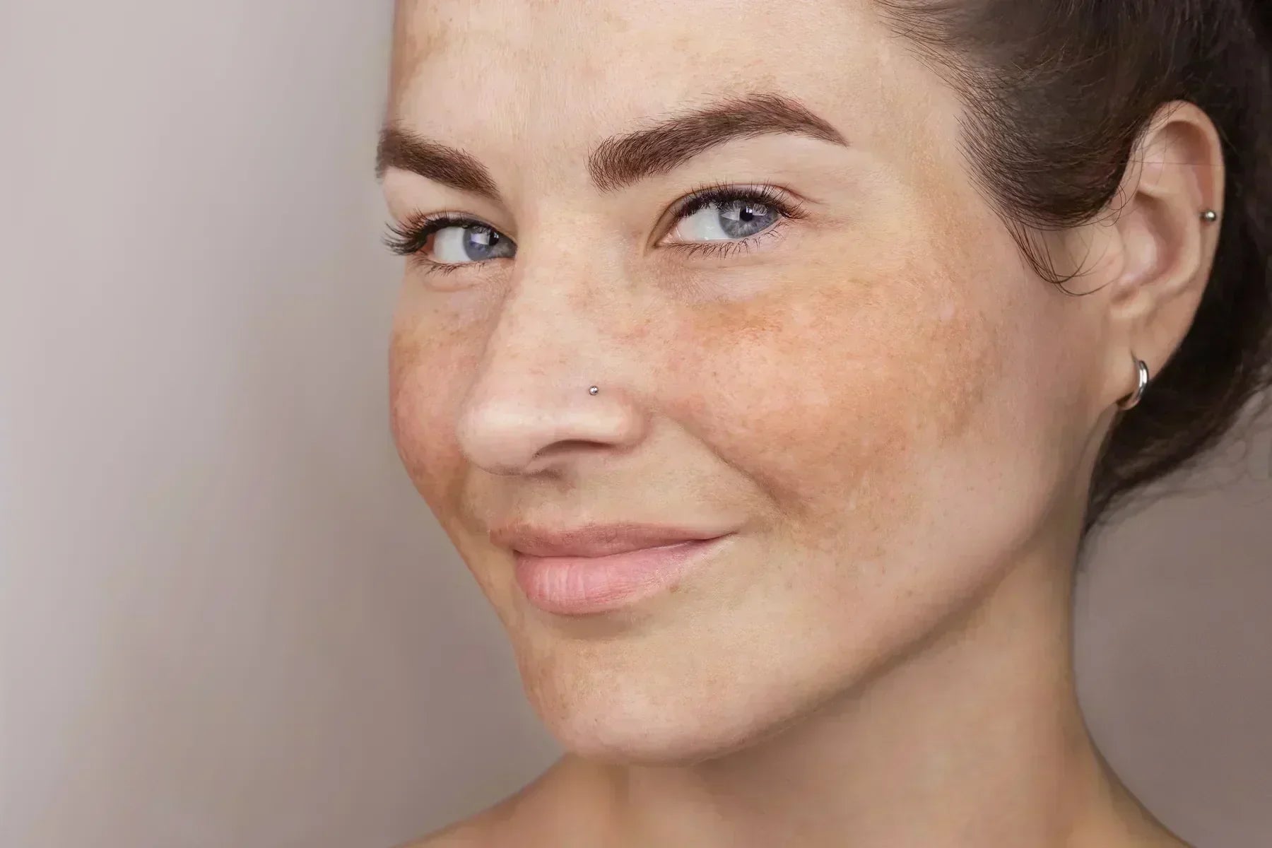 Mujer con manchas faciales