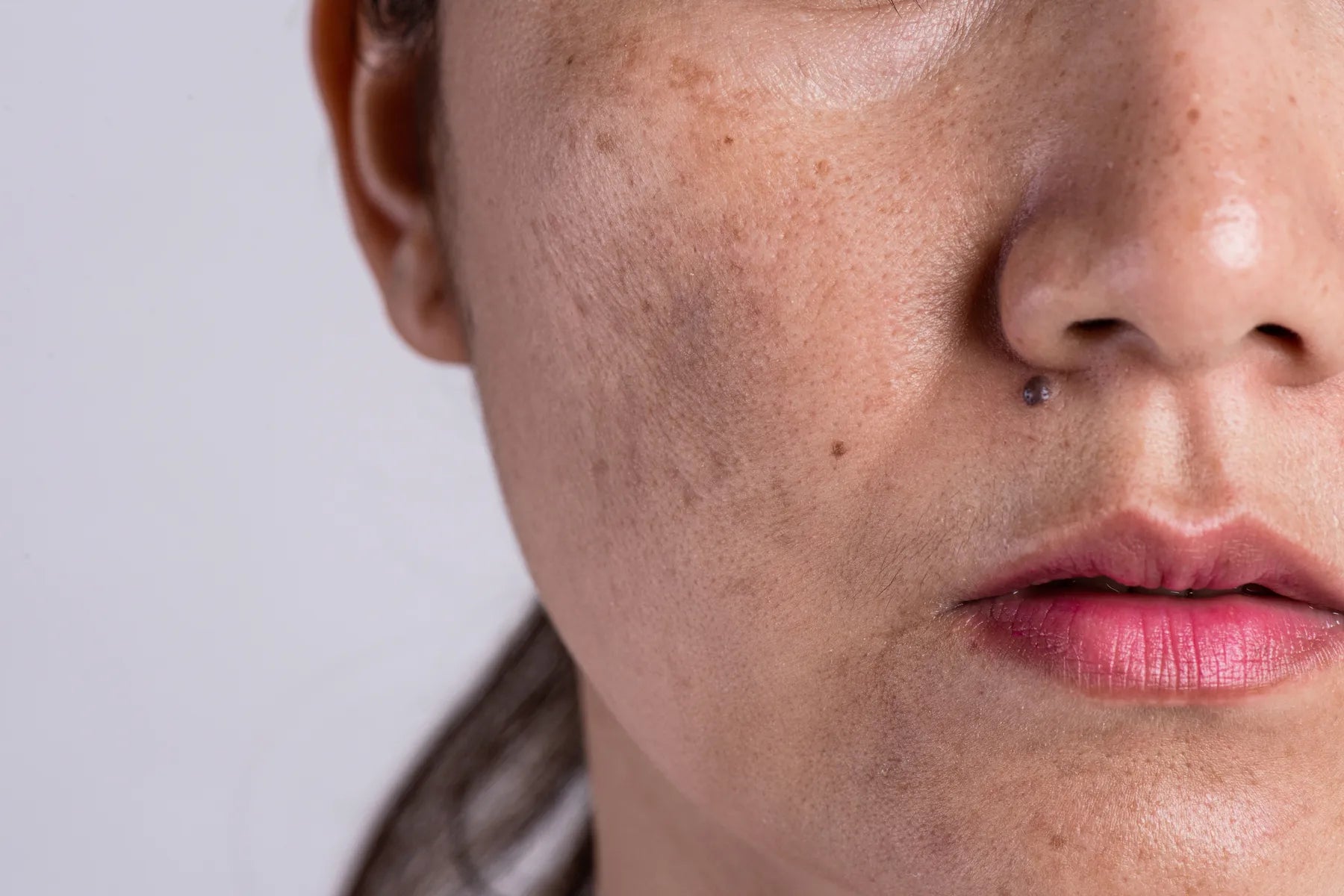 Rostro de mujer con manchas faciales