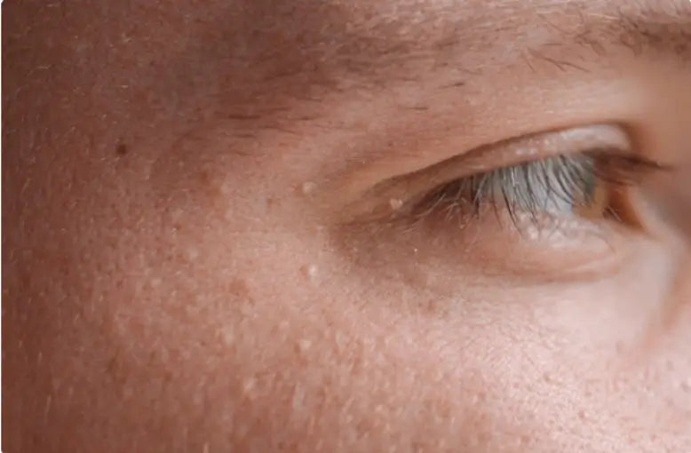 Qué son los quistes de millium y cómo eliminarlos