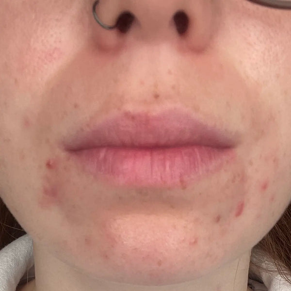 Antes Rutina Antiedad Renovadora- Manchas, arrugas e imperfecciones