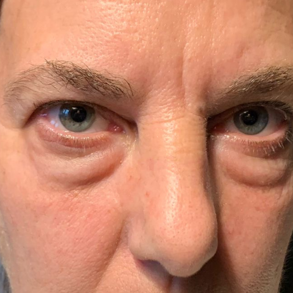 Antes Rutina Contorno de ojos Día y Noche - Ojeras, bolsas y arrugas