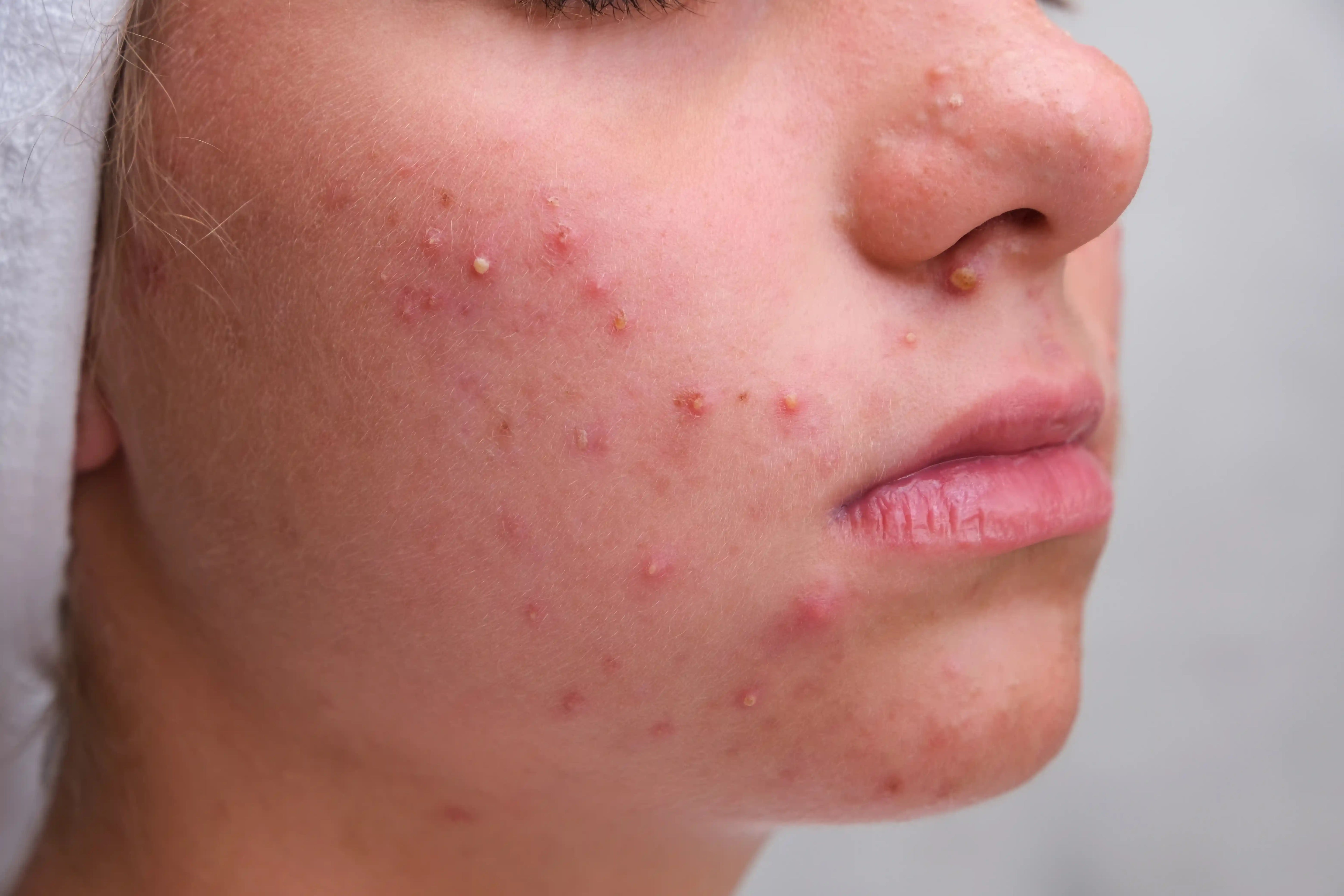 Mujer de perfil con multitud de granos en su rostro